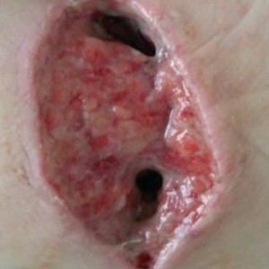 Postoperatieve wonden
